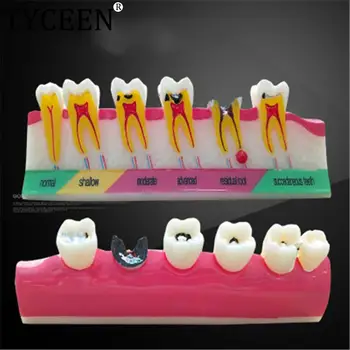 Dantų ėduonis klasifikuoti modelį Dantų modelio demonstravimas Mokyti studijuoti Dantų dantų ėduonis Evoliucija sugedęs dantis Analizės modelis